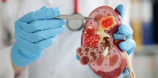 Jangan Anggap Sepele, Ciri-ciri Ginjal Rusak yang Bisa Dilihat dari Urine Ciri-ciri Ginjal Rusak